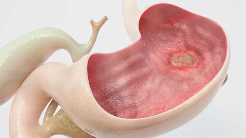 Trà dây diệt vi khuẩn gây loét dạ dày và nóng trong người