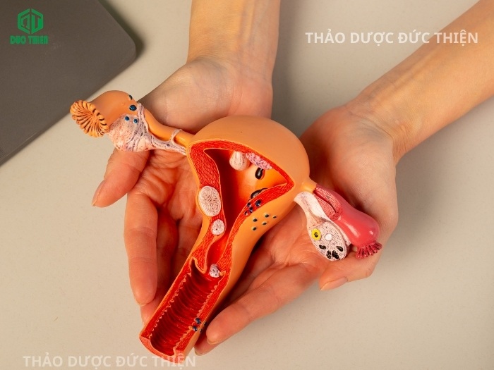 Mô hình y khoa minh họa vị trí các khối u xơ và nang nước thường gặp ở tử cung phụ nữ