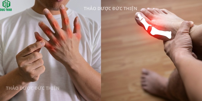 Tác dụng của chuối hột rừng trong việc hỗ trợ điều trị bệnh Gout, giúp giảm sưng tấy và đau nhức các khớp xương.