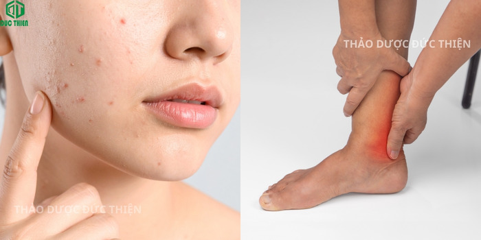 Công dụng của lá tía tô khô hỗ trợ giảm mụn và đau xương khớp
