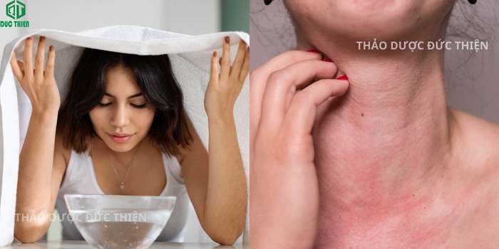 Hướng dẫn dùng lá tía tô khô xông mặt giải cảm và trị dị ứng mẩn ngứa