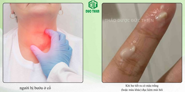 Cây ké hoa đào - Khắc tinh của bệnh bướu cổ và khí hư