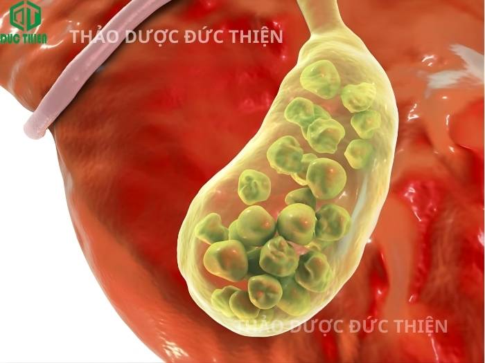 Quả dứa dại hỗ trợ hiệu quả trong việc trị sỏi thận, sỏi tiết niệu