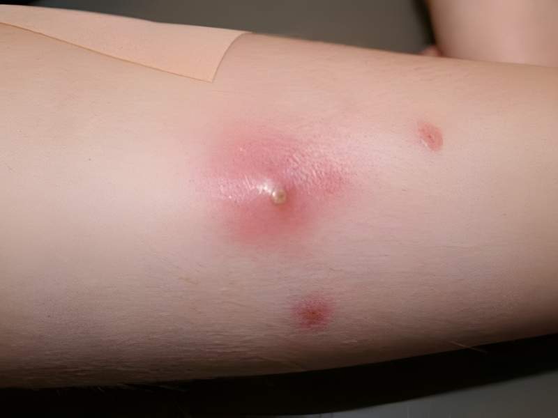 Cây xạ đen trị viêm lở loét, mụn nhọt và các bệnh ngoài da ở người